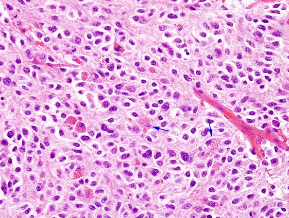 6C4 Oligodendroglioma, anaplastic (Case 6) H&E 6 copy