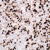 6D Oligodendroglioma, anaplastic (Case 6) MIB