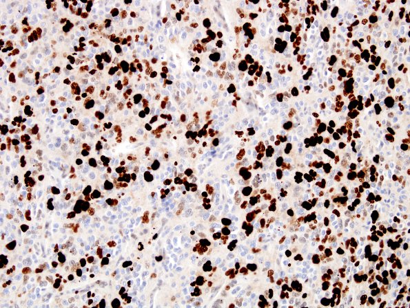 6D Oligodendroglioma, anaplastic (Case 6) MIB