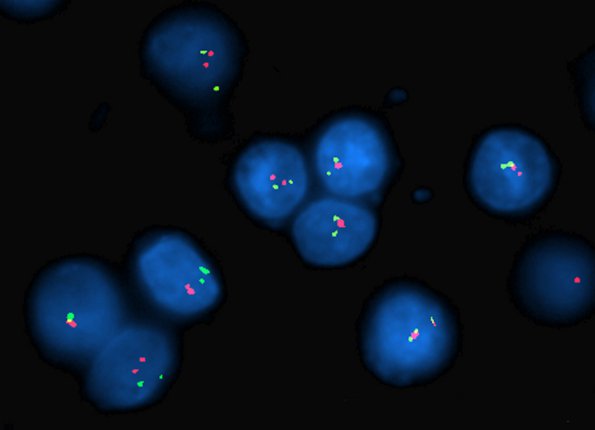 7A2 Oligodendroglioma control (Case 7A) 19p19q Normal 1p green 1q red. - Copy