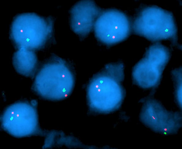 7B1 Oligodendroglioma -1p 1q (Case 7B1)-2 cropped - Copy