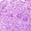 8A1 Oligodendroglioma, anaplastic (Case 8) H&E 1