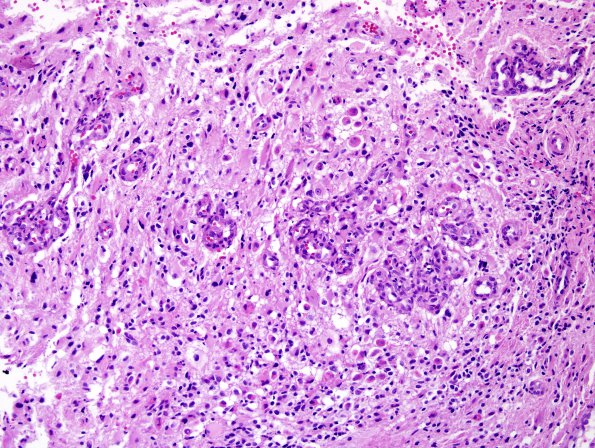 8A1 Oligodendroglioma, anaplastic (Case 8) H&E 1