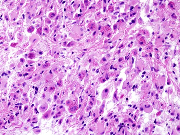 8A2 Oligodendroglioma, anaplastic (Case 8) H&E 6