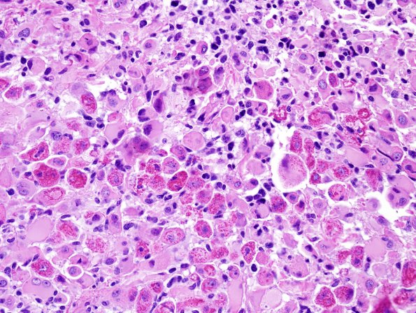 8A3 Oligodendroglioma, anaplastic (Case 8) H&E 13