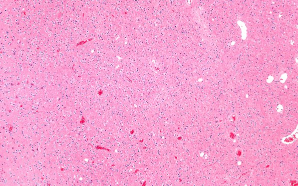 9B2 Oligodendroglioma, focal anaplasia (Case 9) 10X