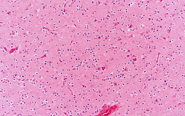 9B3 Oligodendroglioma, focal anaplasia (Case 9) 20X