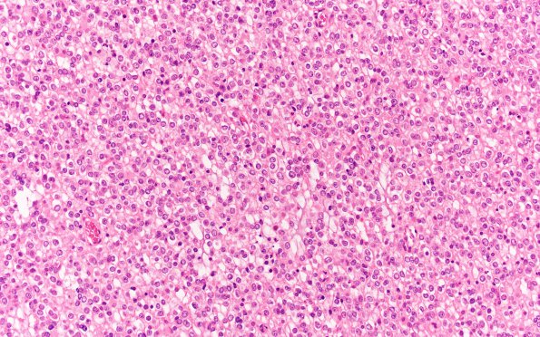 10A Oligodendroglioma Grade 2 (Case 10) H&E 20X