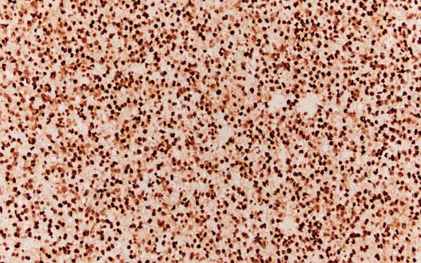 10D Oligodendroglioma Grade 2 (Case 10) ATRX 20X