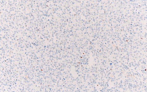 10E Oligodendroglioma Grade 2 (Case 10) p53 20X