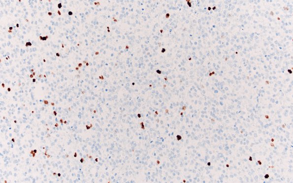 10F Oligodendroglioma Grade 2 (Case 10) Ki67 20X