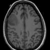 11A1 Oligodendroglioma, WHO II (Case 11) T1 - Copy