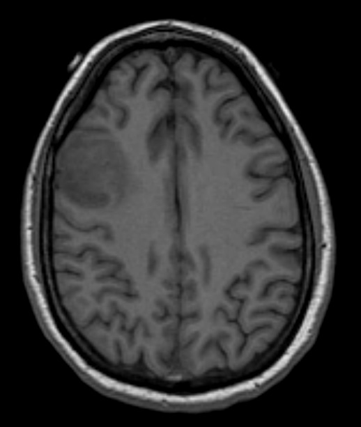 11A1 Oligodendroglioma, WHO II (Case 11) T1 - Copy