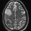 11A2 Oligodendroglioma, WHO II (Case 11) T2 - Copy