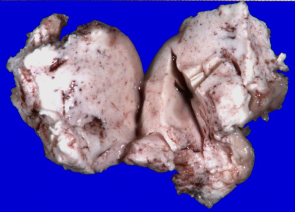 11B Oligodendroglioma WHO II (Case 11)