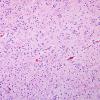 11C Oligodendroglioma, WHO II (Case 11) H&E 1.jpg