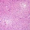 12A1 Oligodendroglioma, Grade 2 (Case 12) H&E 2.jpg