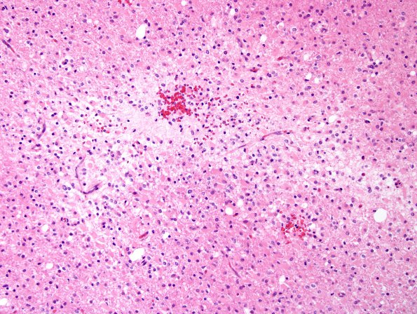 12A2 Oligodendroglioma, Grade 2 (Case 12) H&E 3.jpg