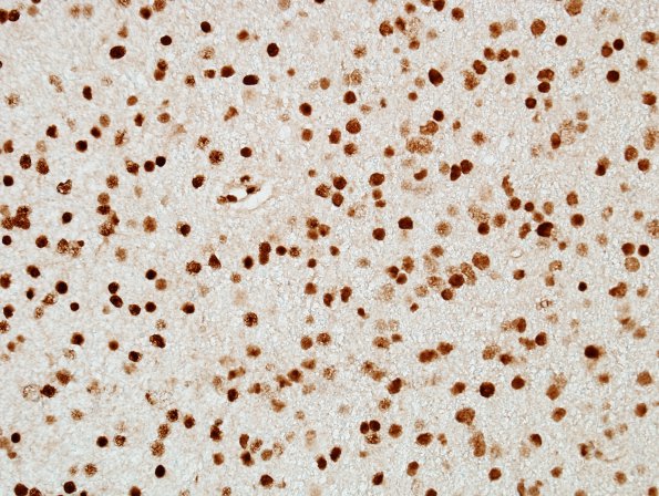 12D Oligodendroglioma, Grade 2 (Case 12) ATRX.jpg