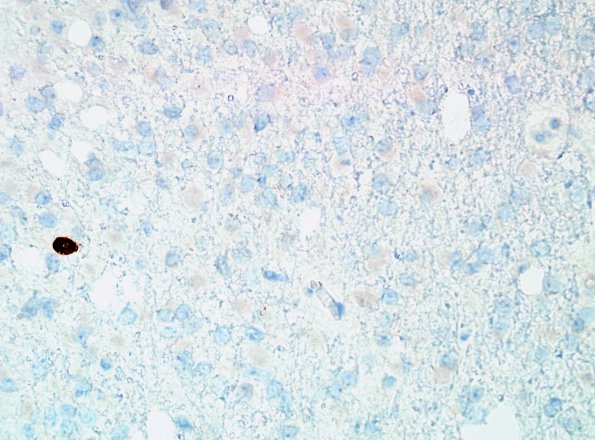 12E Oligodendroglioma, Grade 2 (Case 12) p53.jpg