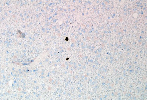 12F Oligodendroglioma, Grade 2 (Case 12) Ki67 1.jpg