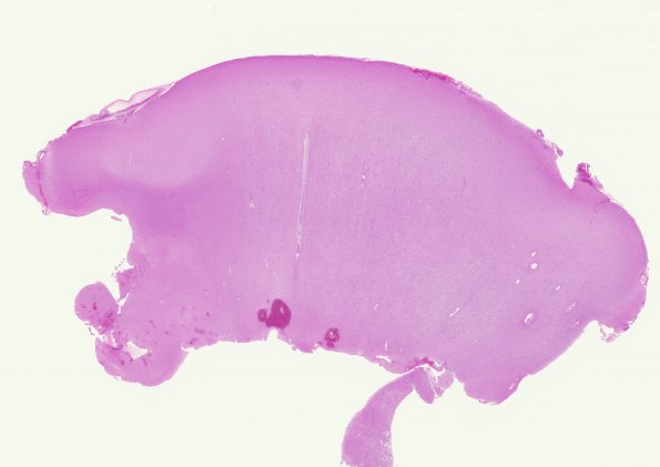 13A1 Oligodendroglioma, Grade II (Case 13) H&E whole mount