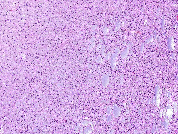 13A2 Oligodendroglioma, Grade II (Case 13) H&E 13.jpg