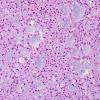 13A3 Oligodendroglioma, Grade II (Case 13) H&E 11.jpg