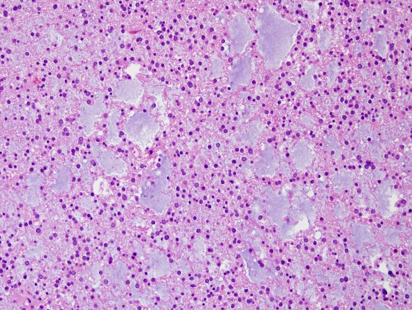 13A3 Oligodendroglioma, Grade II (Case 13) H&E 11.jpg