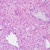 13A4 Oligodendroglioma, Grade II (Case 13) H&E 6.jpg