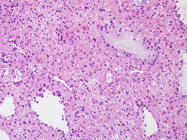 13A4 Oligodendroglioma, Grade II (Case 13) H&E 6.jpg