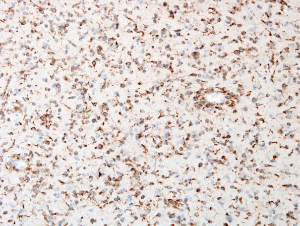 13B2 Oligodendroglioma, Grade II (Case 13) H&E IDH 7.jpg