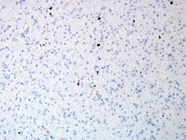 13C Oligodendroglioma, Grade II (Case 13) H&E Ki67.jpg