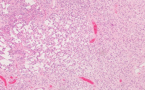 15A1 Oligodendroglioma Grade 2 (Case 15) H&E 10X 1