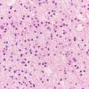 15A2 Oligodendroglioma Grade 2 (Case 15) H&E 40X 1