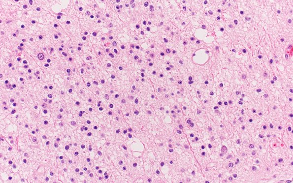 15A2 Oligodendroglioma Grade 2 (Case 15) H&E 40X 1