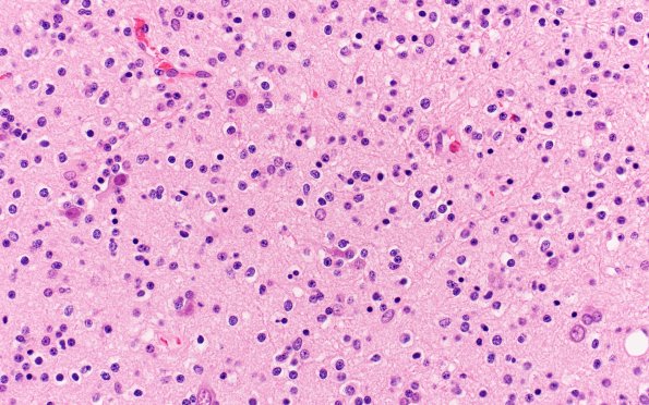 15A3 Oligodendroglioma Grade 2 (Case 15) H&E 40X 3