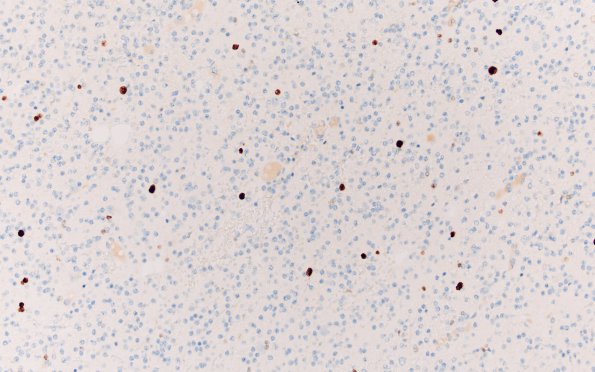 15E Oligodendroglioma Grade 2 (Case 15) Ki67 20X 1