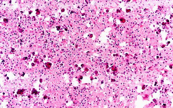 16A2 Oligodendroglioma Grade 2 (Case 16) H&E 20X 1