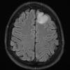 17A1 Oligodendroglioma, WHO II (Case 17) Flair 1 - Copy