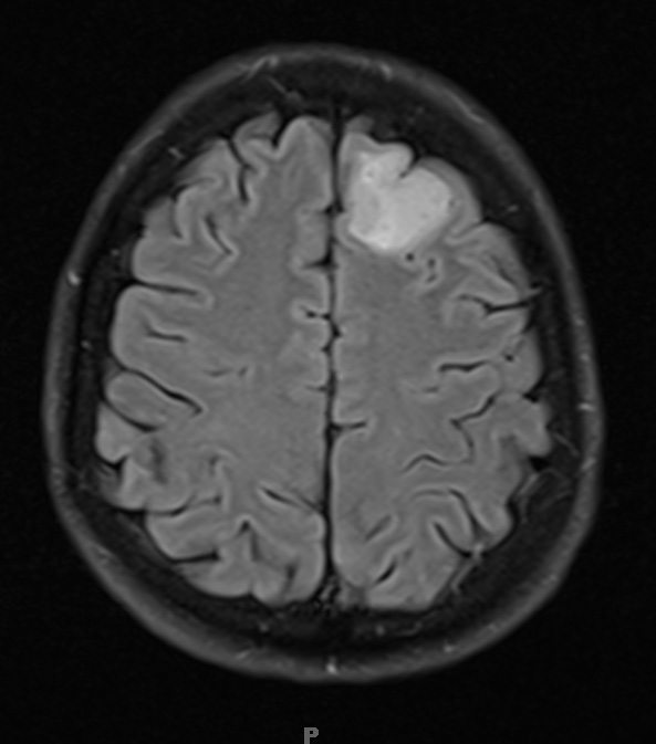 17A1 Oligodendroglioma, WHO II (Case 17) Flair 1 - Copy