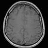 17A2 Oligodendroglioma, WHO II (Case 17) T1 W1 - Copy