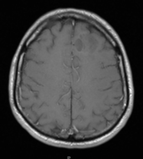 17A2 Oligodendroglioma, WHO II (Case 17) T1 W1 - Copy