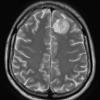 17A3 Oligodendroglioma, WHO II (Case 17) T2 W1 - Copy