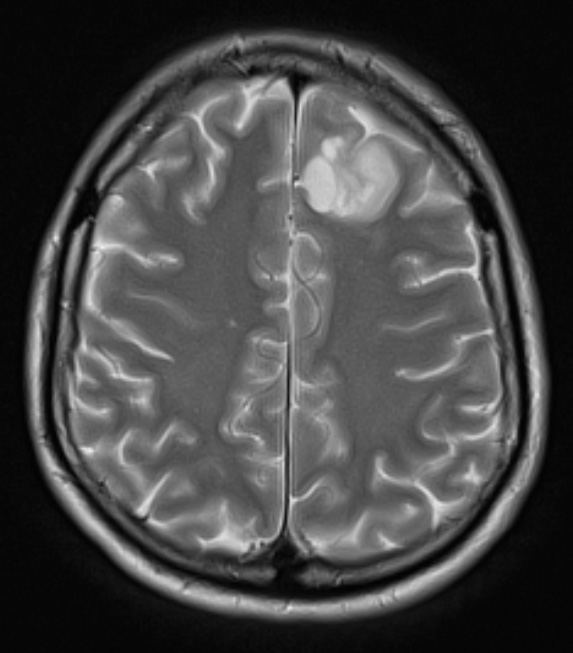 17A3 Oligodendroglioma, WHO II (Case 17) T2 W1 - Copy