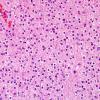 17B1 Oligodendroglioma, WHO II (Case 17) H&E 2.jpg