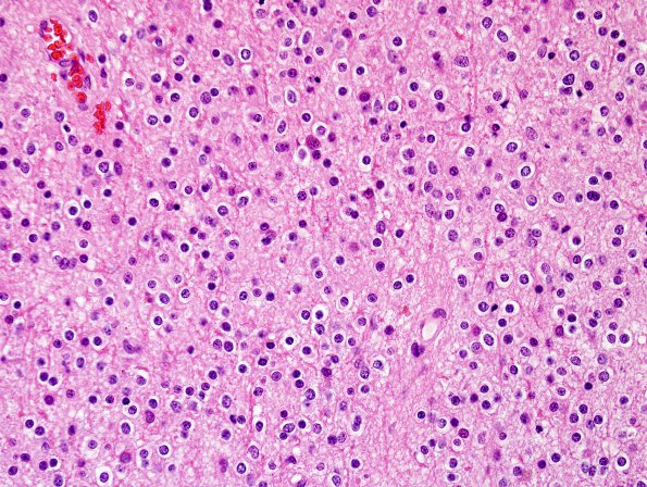 17B1 Oligodendroglioma, WHO II (Case 17) H&E 2.jpg