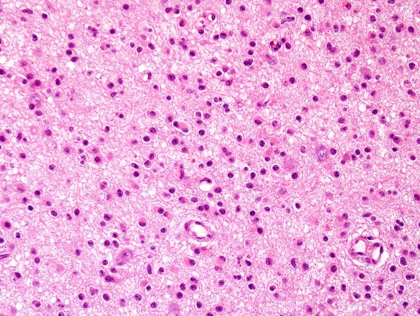 17B2 Oligodendroglioma, WHO II (Case 17) H&E 1.jpg