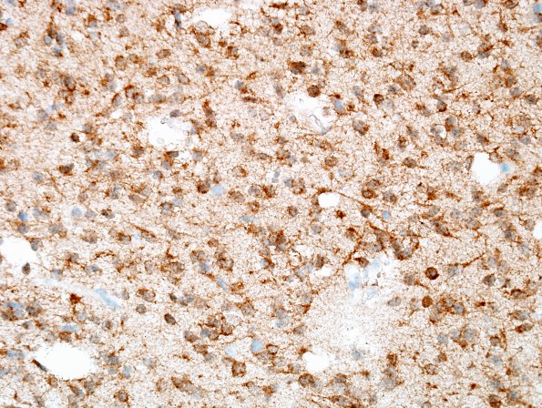 17C Oligodendroglioma, WHO II (Case 17) IDH1 1.jpg