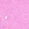 18A1 Oligodendroglioma, WHO II (Case 18) H&E 1